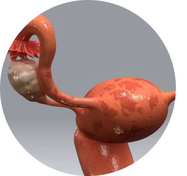 Imagem Endometriose