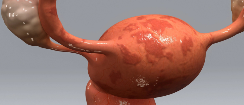 Imagem Endometriose